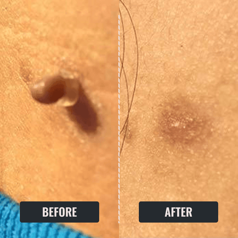 Beldogne® Skin Tag Remover